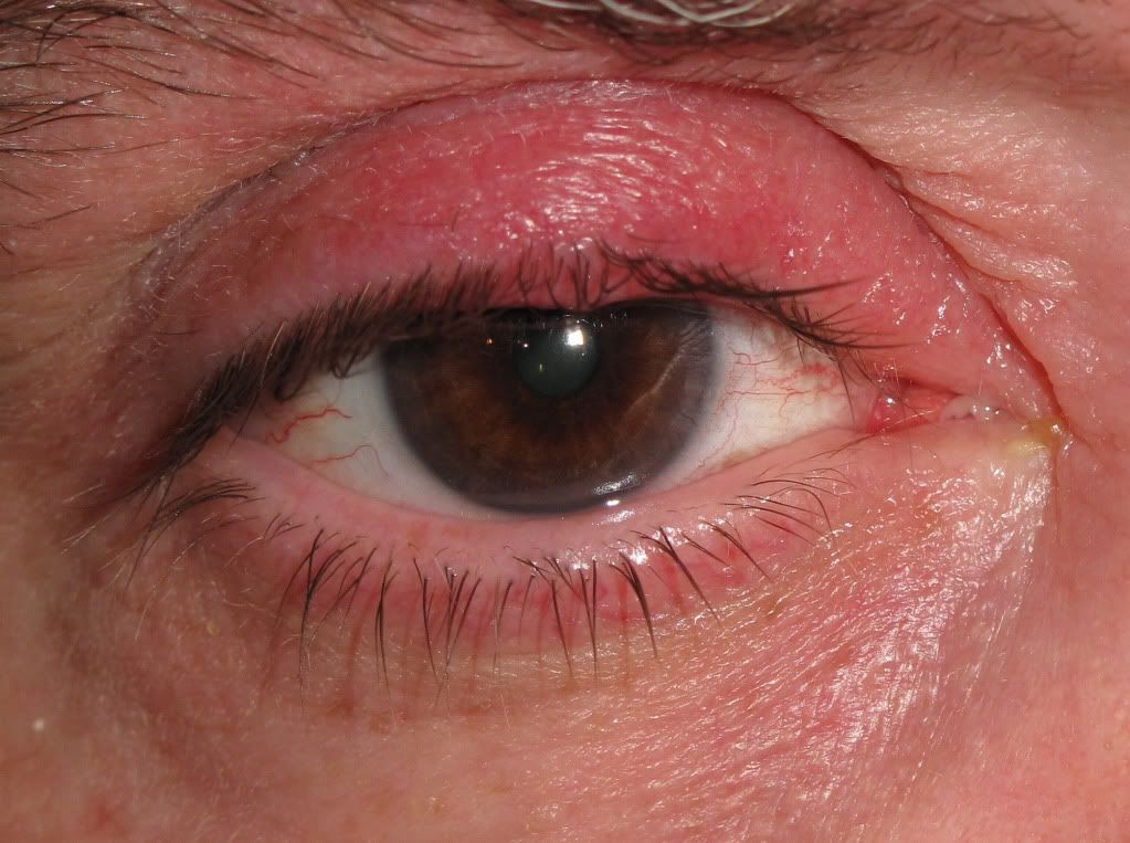 External Stye 3 Photo by MedFoto Photobucket